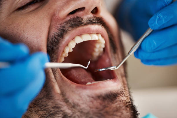 Best Emergency Root Canal Treatment in Ocean City, FL